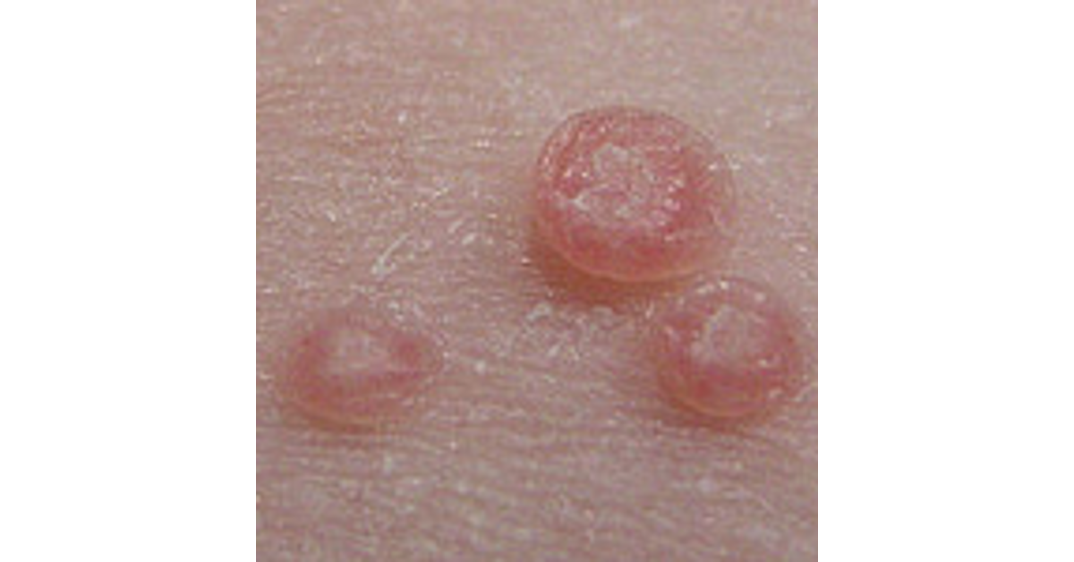 A bőrgyógyász legjobb tanácsai szemölcs ellen - Dermatica