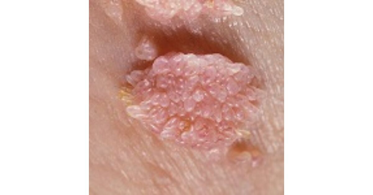 condyloma bőrbetegség