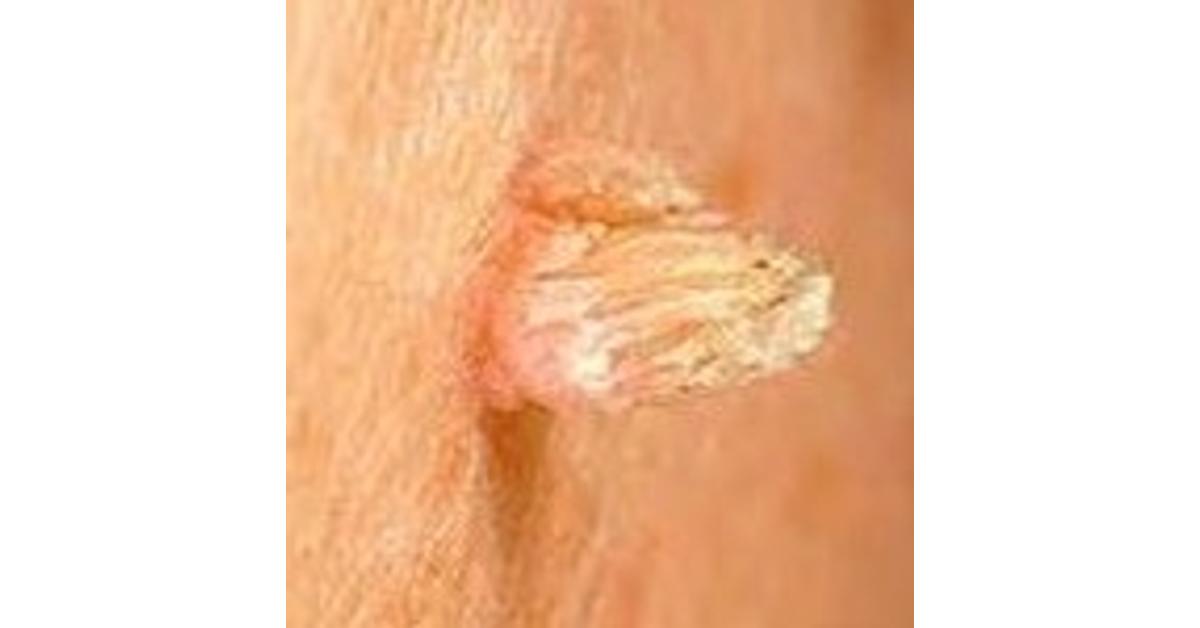 mit jelent a papilláris urothelialis laphámsejtes genitális papilloma